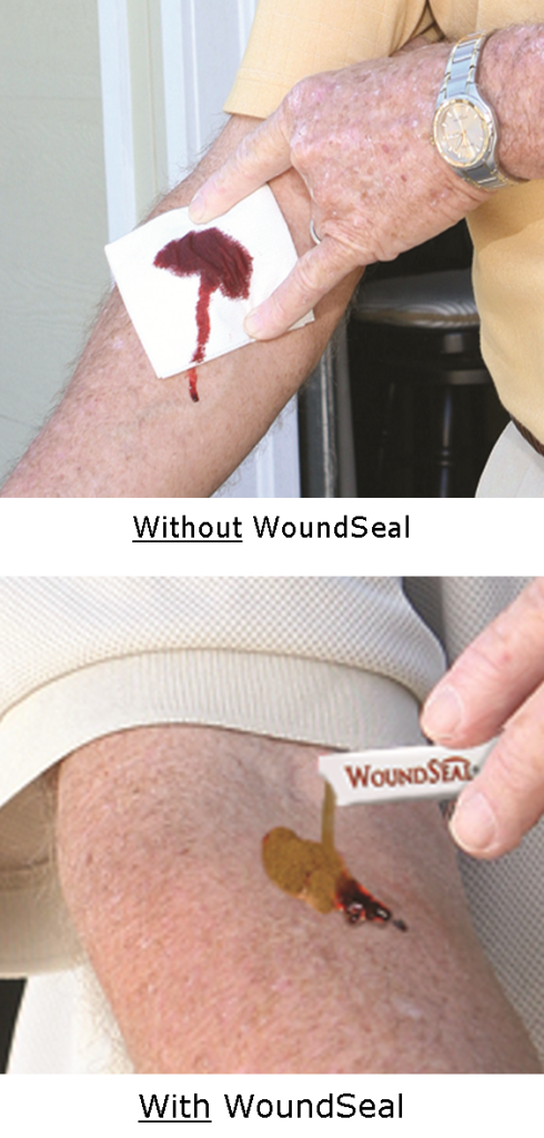 With Without WoundSeal